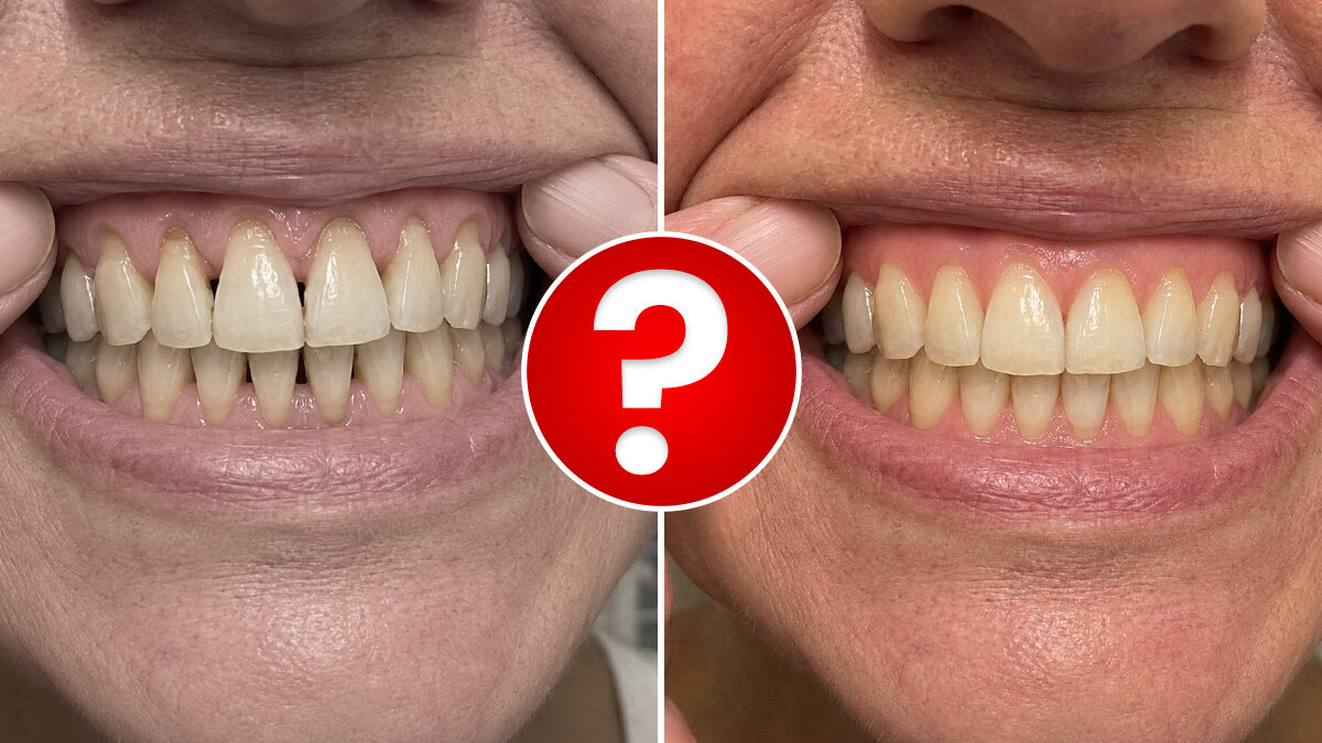 Can Receding Gums Really Grow Back? A Toronto MD Says Yes, And It Comes Down To THIS One Thing Dentists Overlook
